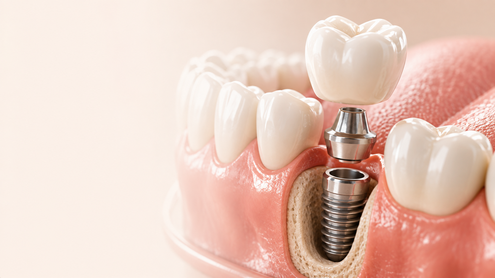 Implant dentar cu coroană zirconiu la Zento Clinic