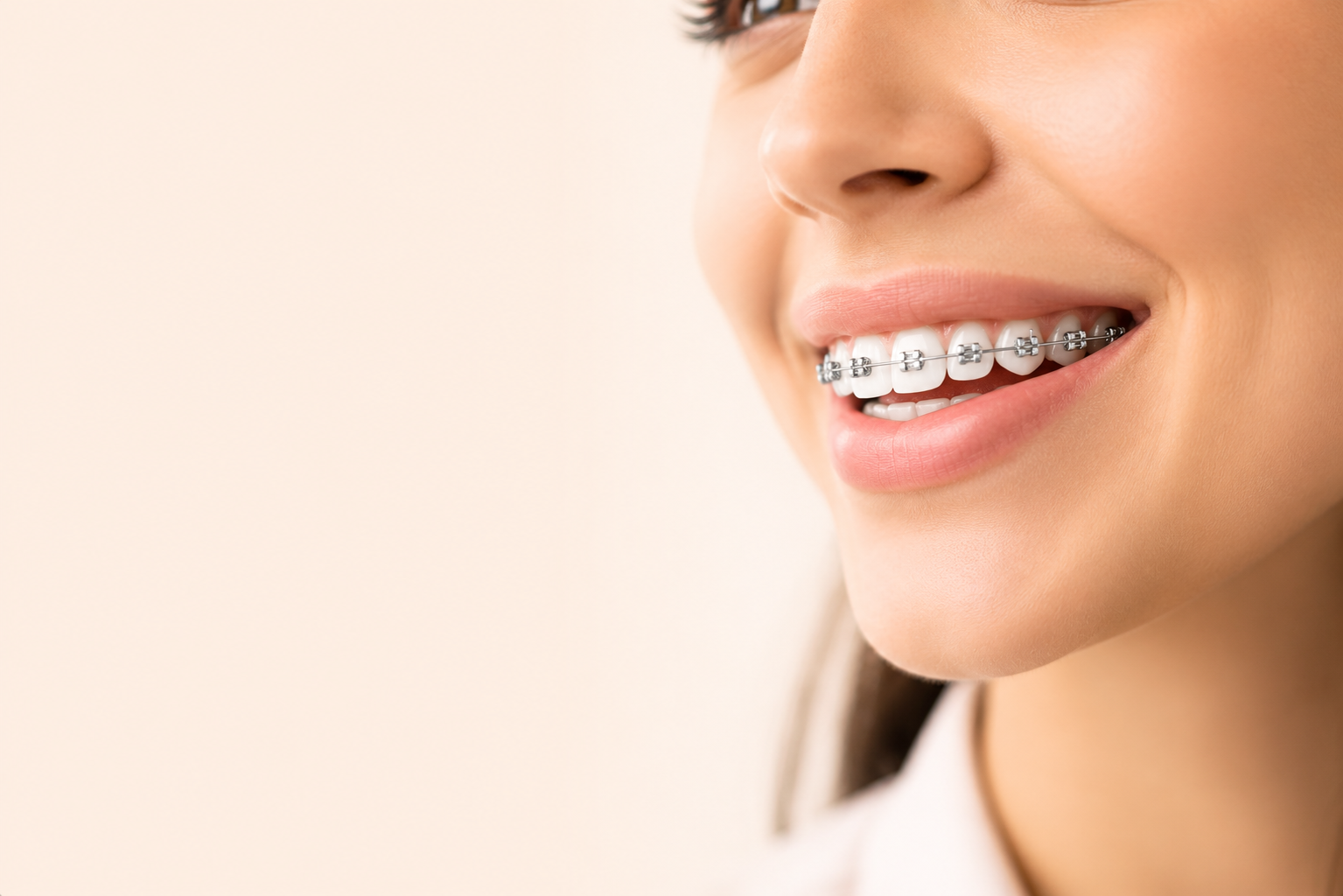 Zâmbet cu aparat dentar fix - pacient Zento Clinic