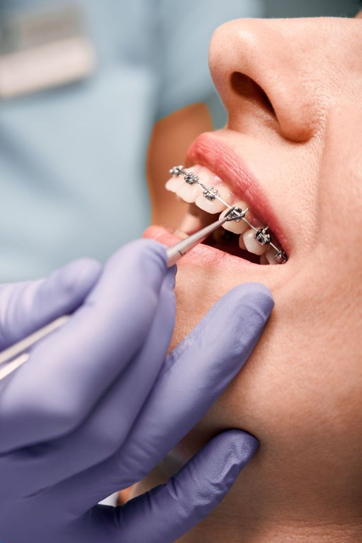 Aparat dentar metalic fix
