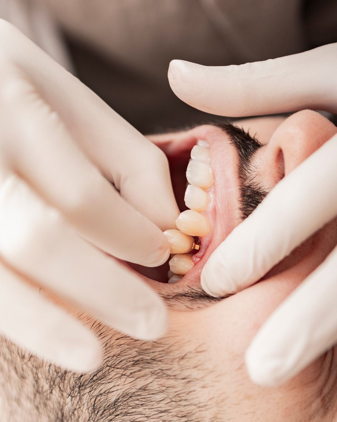 Implant dentar și coroană zirconiu